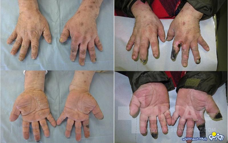 نکروز چیست و راه‌های درمان آن کدام است؟