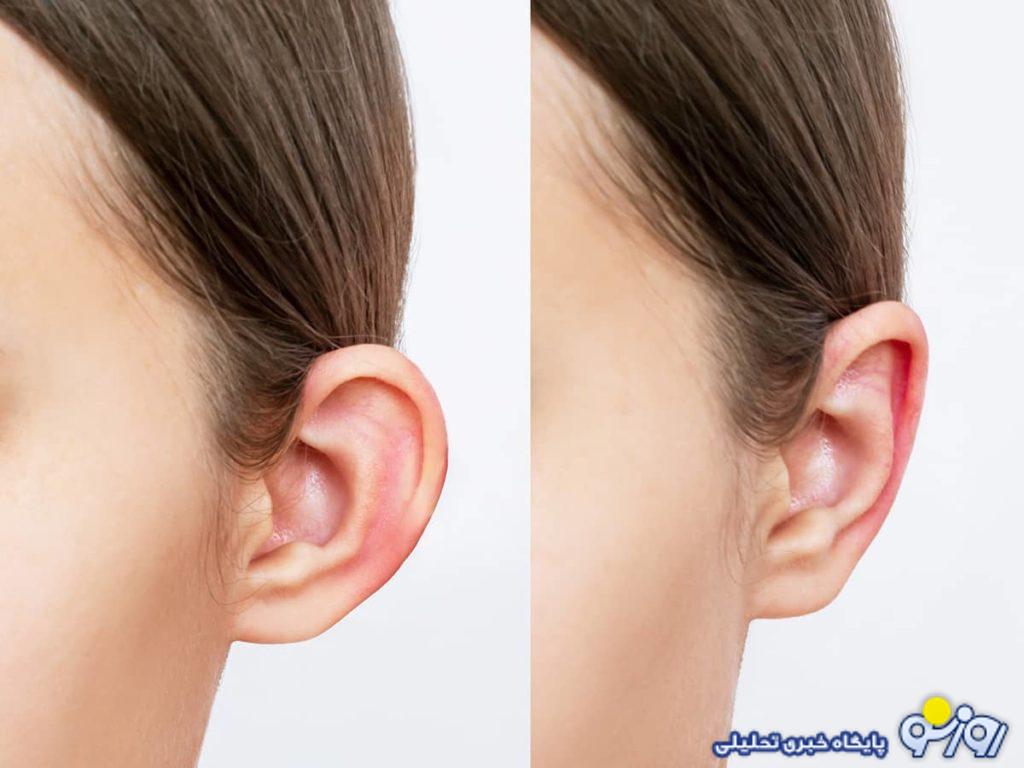 عمل اتوپلاستی چیست و چه کسانی نیاز به آن دارند؟